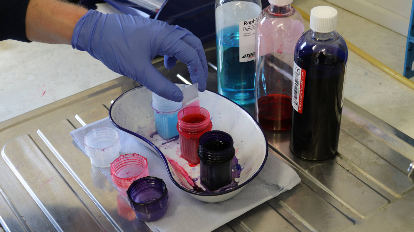 Haematology blood smear being stained